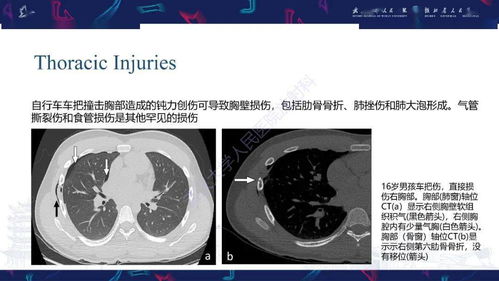 推荐丨小儿车把伤CT诊断