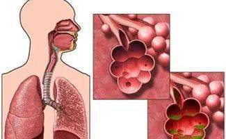 什么是慢阻肺 祝您健康 昭通市第一人民医院熊春燕医生告诉您