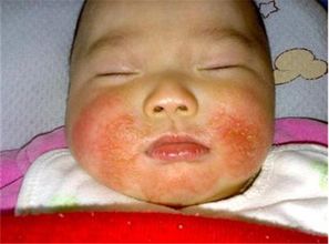 刚出生的新生儿湿疹的主要原因有哪些是不是和妈妈有关