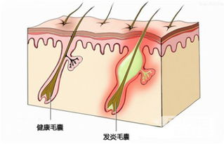 毛囊是什么样子