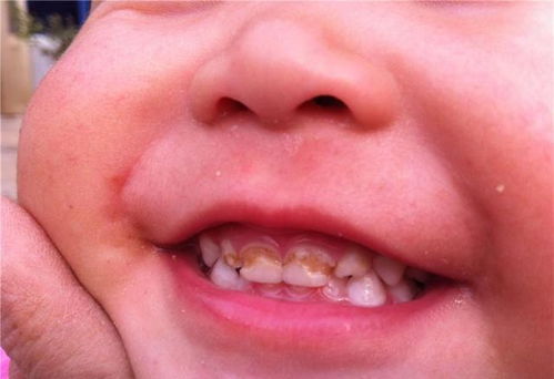 3岁半宝宝牙齿 全烂光 ,家长这些行为,是孩子烂牙的 帮凶