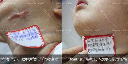 郑州市第二中医院 外伤疤痕有哪些类型 该怎样治疗