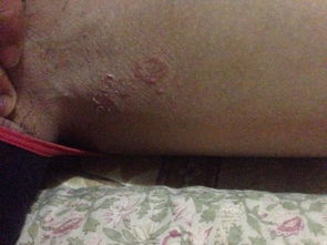 我这是湿疹还是股癣 在大腿根部内侧 两条腿都会 几天前还是个小疙瘩 