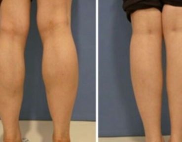 瘦腿大作战 15天成功瘦了4厘米,肌肉腿变成小细腿