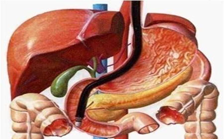 儿童复发性胰腺炎的重要原因 胰管分裂