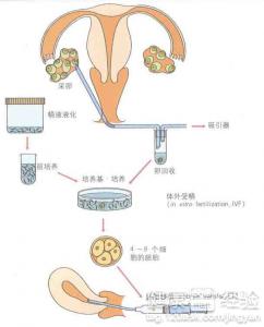 我患子宫纵膈怎么办术后能做试管婴儿吗