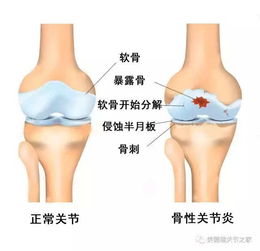 玻璃酸钠注射液对关节有什么好处呢