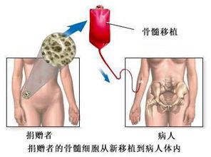 骨髓移植术 骨髓获取 正常解剖 手术指针 手术过程和手术预后 图片