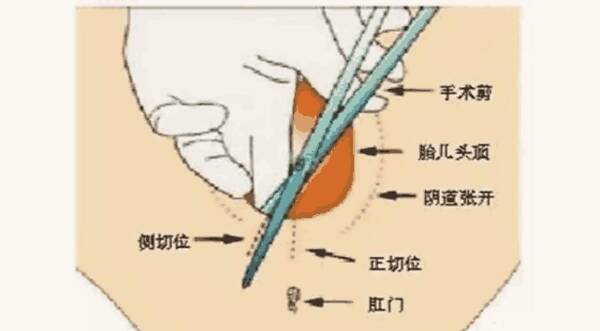 生小孩顺产侧切图片图片