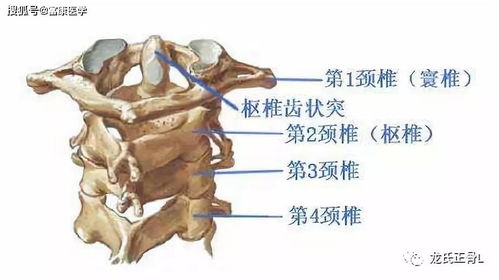 颈椎半脱位