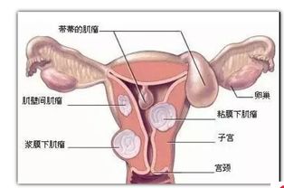 妈妈做了子宫肌瘤手术，切除了一半子宫，几年后又来月经了？怎么回事？