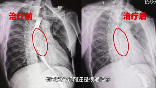 食道癌无法进食怎么办(食道癌无法进食怎么办能活多久)