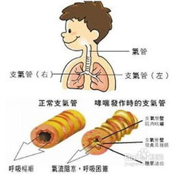 支气管哮喘症状有哪些
