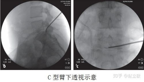 腰椎间孔镜手术你了解多少 