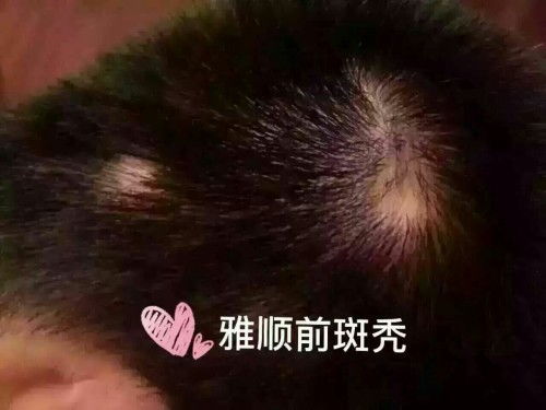 头发和眉毛越来越少怎么回事？怎么办？