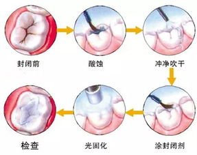 今年的小学生六龄齿免费窝沟封闭项目启动啦 您家的孩子还等什么 