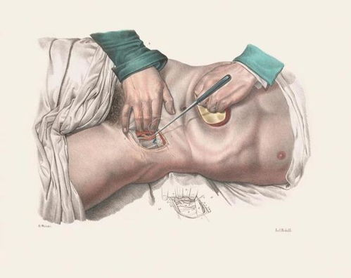 19世纪外科手术图鉴 Richard Barnett 插画艺术