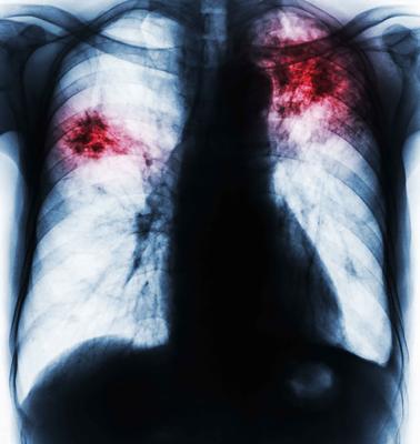 肺癌的中晚期症状(肺癌中晚期症状及表现)