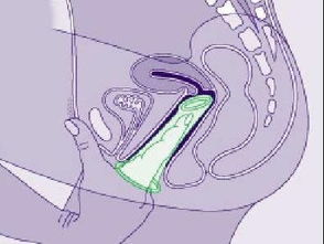 女用避孕套使用方法图 真人示范大功告成 图 