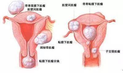 子宫肌瘤和怀孕可以共存吗