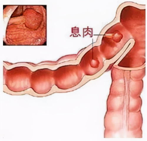 食欲不振 经常腹痛 还便血 45岁以上的人一定要做这个检查