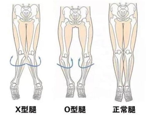为什么有的人腿是直的, 而有的人却是弯的, 这是什么原因导致的
