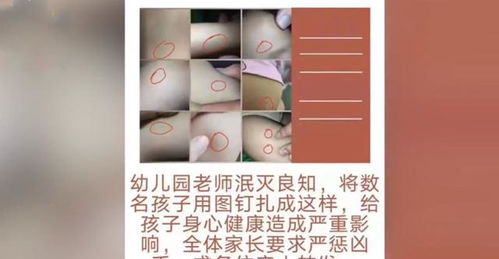 河北幼儿园多名孩子疑被针扎,手脚身上多个伤口 老师说不能告诉妈妈