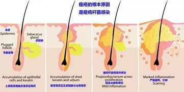 痘痘是怎样形成的