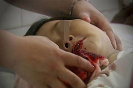六岁女童遭后母毒打吐血 六块脊椎被打断 