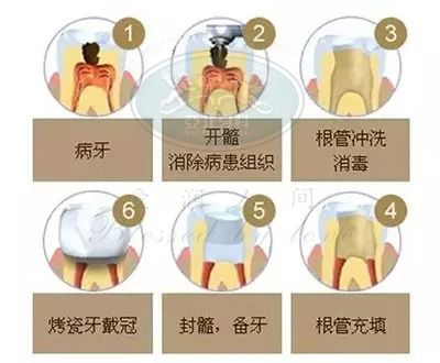 根管治疗后,牙齿寿命会减少