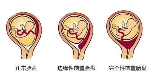 胎盘低置不可小觑,严重可危及胎儿生命 