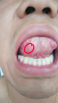 舌头下方有小血块是口腔溃疡吗