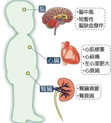 发现血压高,没有任何不舒服,为什么医生还建议要服用降压药