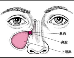 过敏性鼻炎有哪些症状呢 