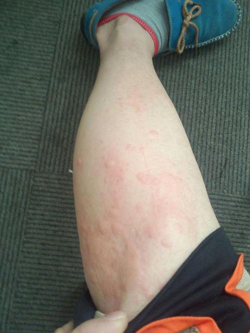 大腿湿疹症状图片图片
