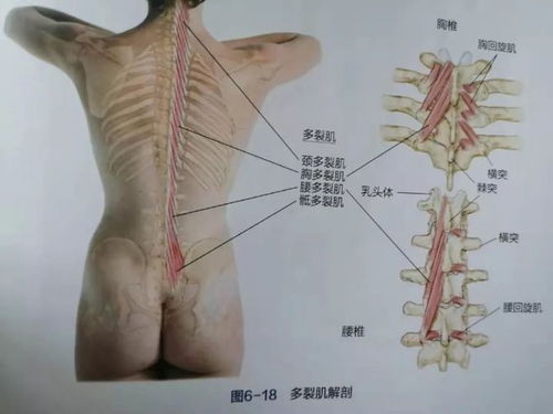 脊柱侧弯 腰痛或跟多裂肌有关,1文教你手法处理和预防训练