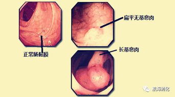 胃肠不好,更不能吸烟 