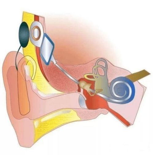 关于人工耳蜗植入你了解多少 一