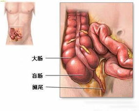 慢性阑尾炎怎么按摩