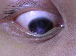 圆锥角膜是一种什么样的眼病(圆锥角膜是啥病)