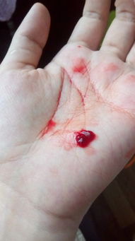 今天手指割破了,我就把血挤出来一些,但是发现血里有这种像血块一样的东西 我流出的血里为什么会有这样 