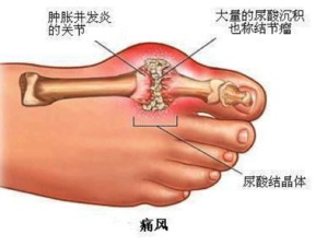 痛风病的神奇治疗方案 半边天乌鸡白凤丸 