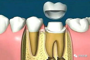 补牙不做冠,疗效少一半 根管治疗后牙齿已经不疼了,为什么还要戴牙冠呢