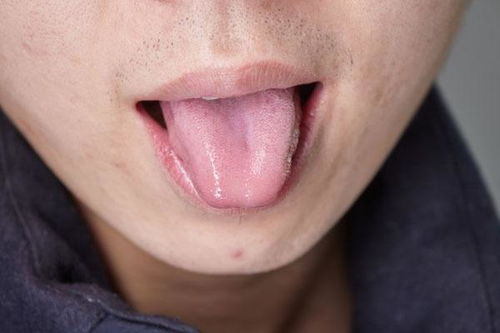 舌苔中间有裂纹是大病的征兆 辟谣 可能不是病理原因注意这几点