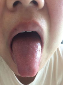 舌头上长了东西 