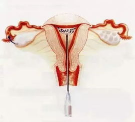 一侧输卵管堵塞可以怀孕吗？做好这3点，提升怀孕几率！