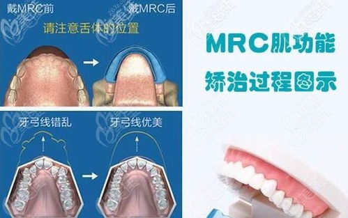 mrc矫正器适合多大儿童矫正 定制款mrc矫正器要带三个疗程