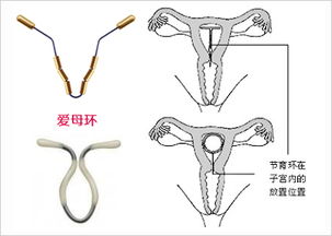 北京哪里有取环的医院 北京取环医院