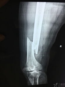 阻挡钉在股骨中下段骨折中的应用 骨科专业讨论版 