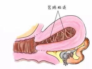 宫腔镜是个啥 有啥用 到底是检查 还是手术